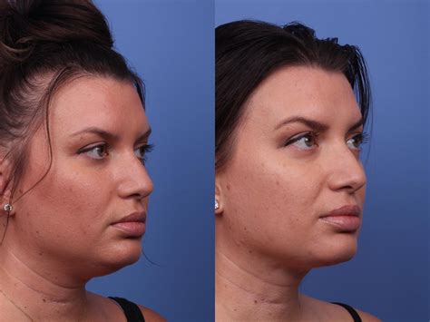 Submental Liposuction Before And After Pictures Case 446 Scottsdale