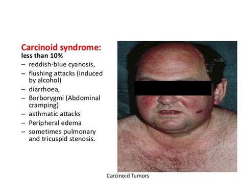 Carcinoid Tumours Of Small Intestine Surgical Aspect