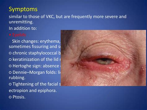 Allergic Conjunctivitis Ppt