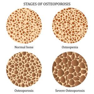 Help to minimize bone loss and osteoporosis with diet and activity