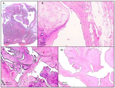 Diagnostics Free Full Text Bilateral Phyllodes Giant Tumor A Case