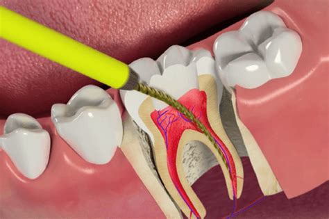 Perawatan Akar Dan Saraf Gigi Klinik Gigi Satu Dental