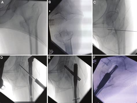 Intraoperative Imaging Findings Of The Patient A And B After Closed