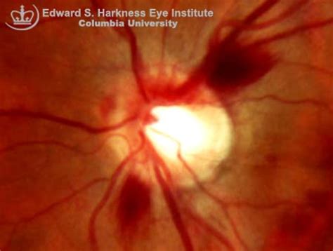 Splinter Optic Disc Hemorrhage | Vagelos College of Physicians and Surgeons