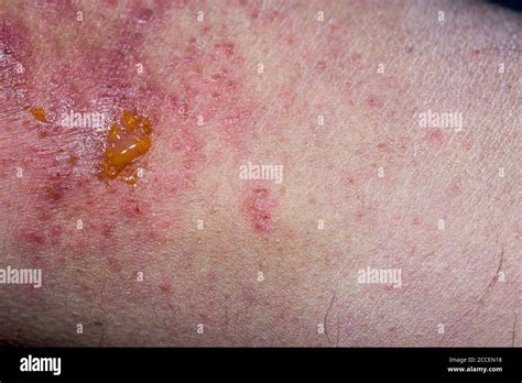 Atopic Dermatitis Elbow