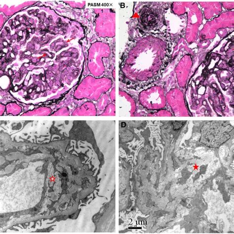 Renal Pathology Of Patient Showing Renal Thrombotic Microangiopathy