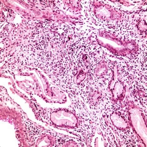 Minimal Deviation Adenocarcinoma Adenoma Malignum Telegraph