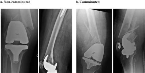 Comminuted Periprosthetic Distal Femoral Fractures Have Greater Postoperative Extension