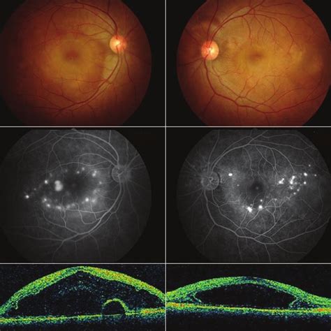 Fundus Photography Fluorescein Angiography Fag And Optical Coherence