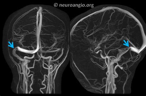 Pulsatile Tinnitus Intracranial Hypertension Persistent Sinus Stenosis