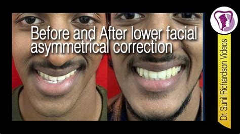 Asymmetrical Face Surgery Before And After