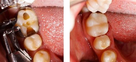 Tooth Cavity Filling