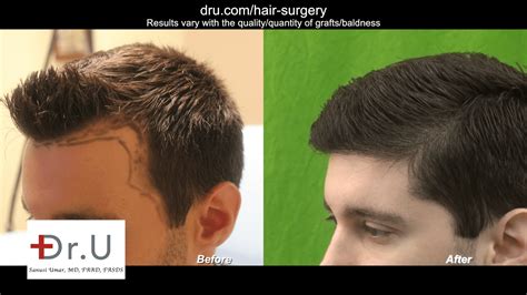 Video Forehead Reduction Using Hair Transplant With Dr Ugraft Fue