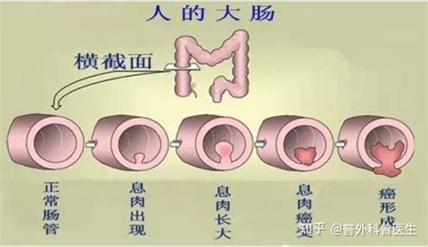 增生、囊肿、息肉、结节和肥大，有什么区别，哪些与癌症有关系？ 知乎