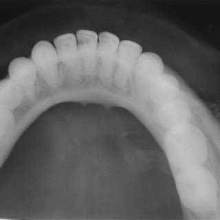 OPG View Shows Well Defi Ned Mixed Radiopaque Radiolucent Lesion With