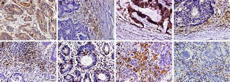 Expression Patterns Of Cmtm6 Pd L1 Cd4 Cd8 Cd68 And Cd163 In Crc