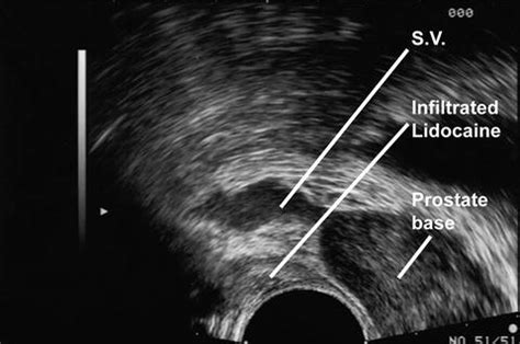 of Prostate Ultrasound for Prostate Biopsy | Oncohema Key