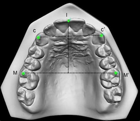 Landmarks Points In The Maxillary Arch For Linear Measurements C C