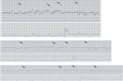 Figo Consensus Guidelines On Intrapartum Fetal Monitoring Cardiotocography Ayres‐de‐campos