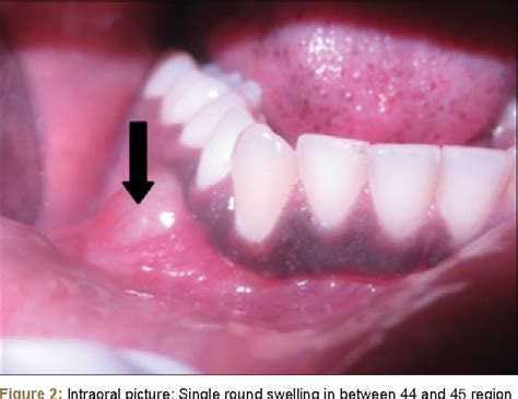 Odontogenic Keratocyst Simulating Lateral Periodontal Cyst A Case