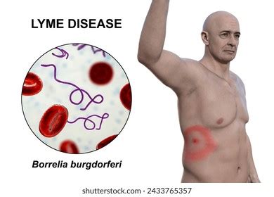 Lo Mejor En La Categor A Erythema Migrans De Im Genes Fotos De Stock