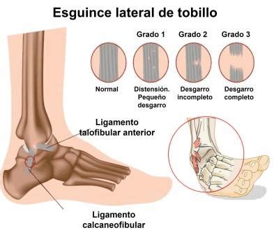 Esguince De Tobillo