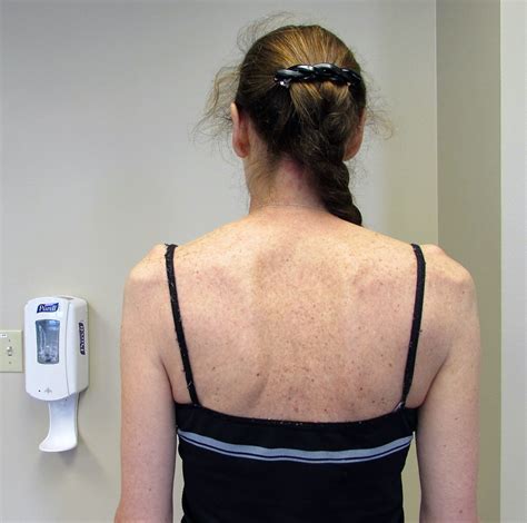 Post Operative Rehabilitation For Scapular Muscle Reattachment A Case Report Published In