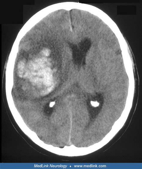 Hemorrhagic Transformation Of Ischemic Stroke Medlink Neurology