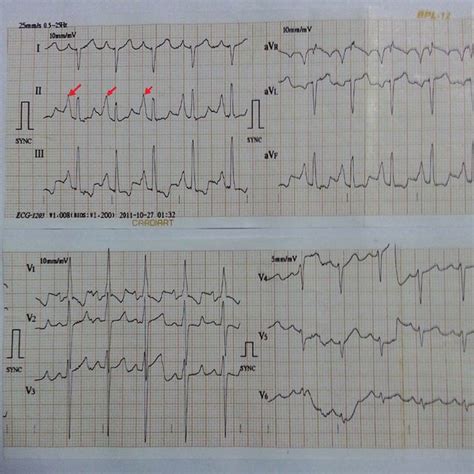 In lead II, III and aVF, P-wave was tall and peaked with maximum P-wave ...