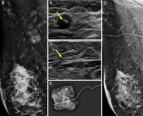 A 30 Year Old Woman With Right Breast Cancer And Ipsilateral Axillary