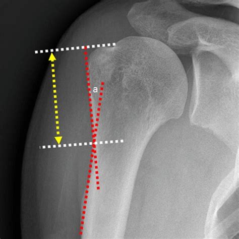 True Anteroposterior Shoulder Plain Radiograph Showing The Lateral