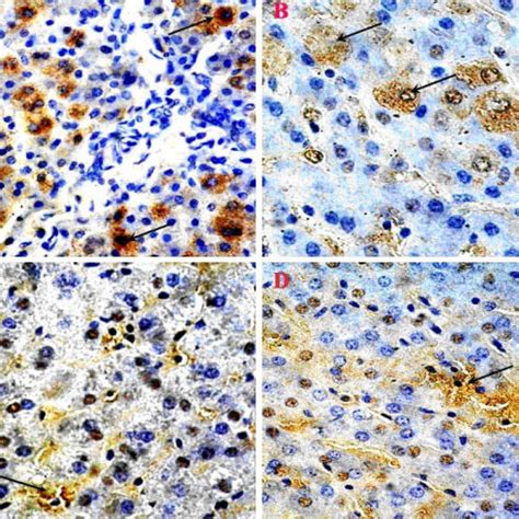 Immunohistochemical Analysis Of Hbsag And Hbcag In Liver Tissues A