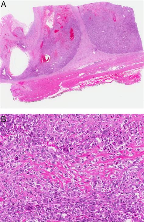 Sarcoma Of The Breast An Update On A Rare Entity Journal Of Clinical