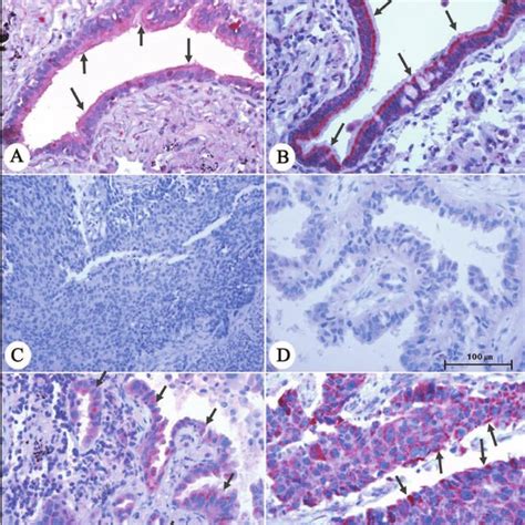 Immunohistochemical Staining Of Neoplastic And Non Neoplastic Lung