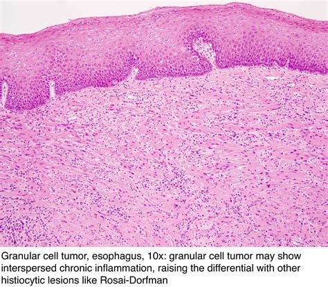 Granular Cell Tumor Larynx