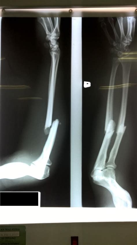 Radius And Ulna Shaft Fracture