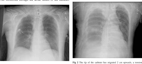 Figure From Tension Hydrothorax Induced By Central Venous Catheter