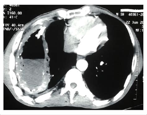 Mediastinal Window Of Thoracic Ct Showing A Calcified Pleural Empyema