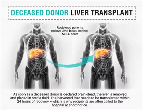 What Is Ddlt Deceased Donor Liver Transplant Score Ailbs India