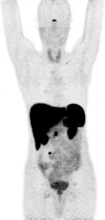 Gallium Dotatate Radiology Reference Article Radiopaedia Org