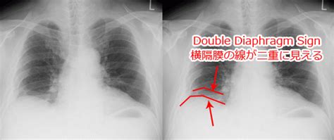 気胸を中心に徹底解説して、さらには縦隔気腫まで纏めてみた！ 読影を中心にradiographica 診療放射線技師のバイブル