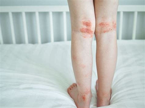 Dermatitis Atópica Qué Es Causas Síntomas Y Tratamiento