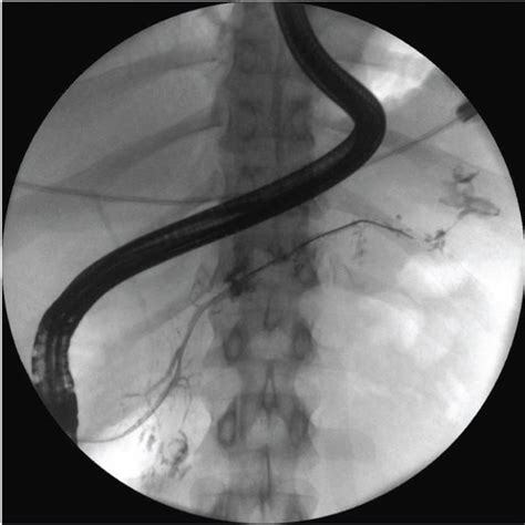 Endoscopic Retrograde Pancreatography Done In The Patient With Wopn