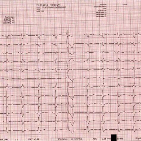 ECG at presentation: Sinus rhythm 63/min, major right bundle branch ...