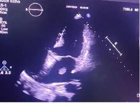 Figure From A Year Old Female With Diffuse Pulmonary Infiltrates