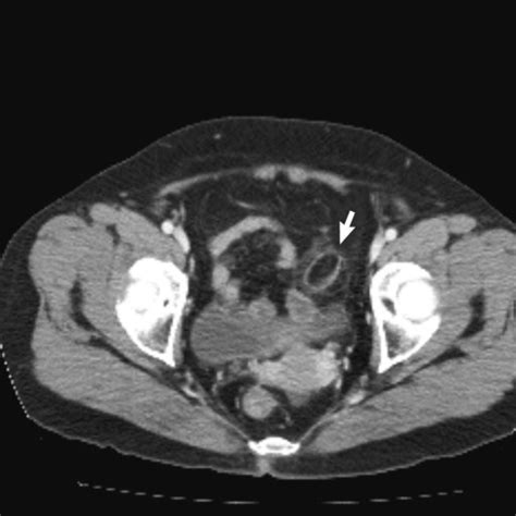 Clinical Features Of Patients With Primary Epiploic Appendagitis