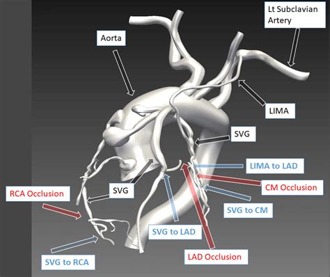 Coronary Bypass Surgery 3d And Quantitative Imaging Laboratory