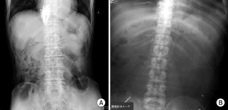 Incorrect Epidural Catheter Placement Of The Imaged Lower Thoracic