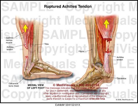 Medivisuals Ruptured Achilles Tendon Medical Illustration