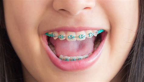 Orthodontist In Ann Arbor Embrace Orthodontics